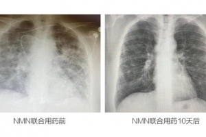 美权威医生用NMN治愈55岁新冠重症：免疫水平一晚提升85%、10天后转阴