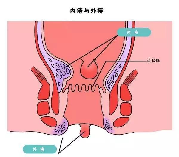 3,肛乳头肥大脱出脱出物呈灰白色或淡黄色,其上的短蒂如鼓槌状,质硬